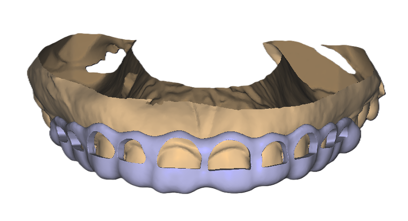 Gingivectomy Guide